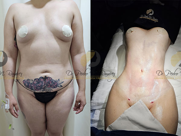 Abdominoplastía (Tummy Tuck) en guadalajara Lipoescultura en Guadalajara