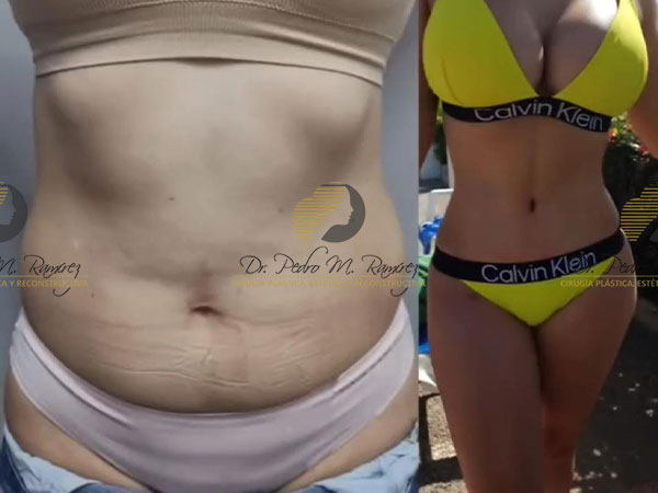 Mommy Makeover precio